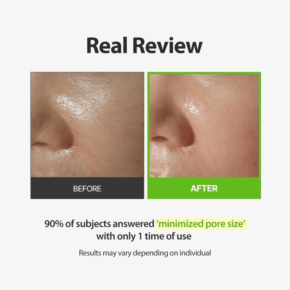 SUNGBOON EDITOR Green Tomato Pore Peeling Jumbo Pad – før- og etterbilde med fokus på synlige porer